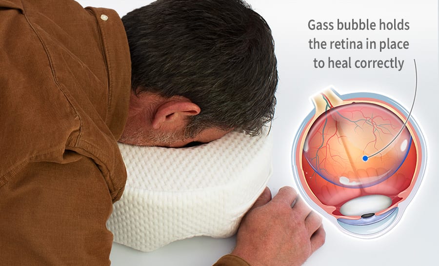 after retina detachment surgery should you your eye