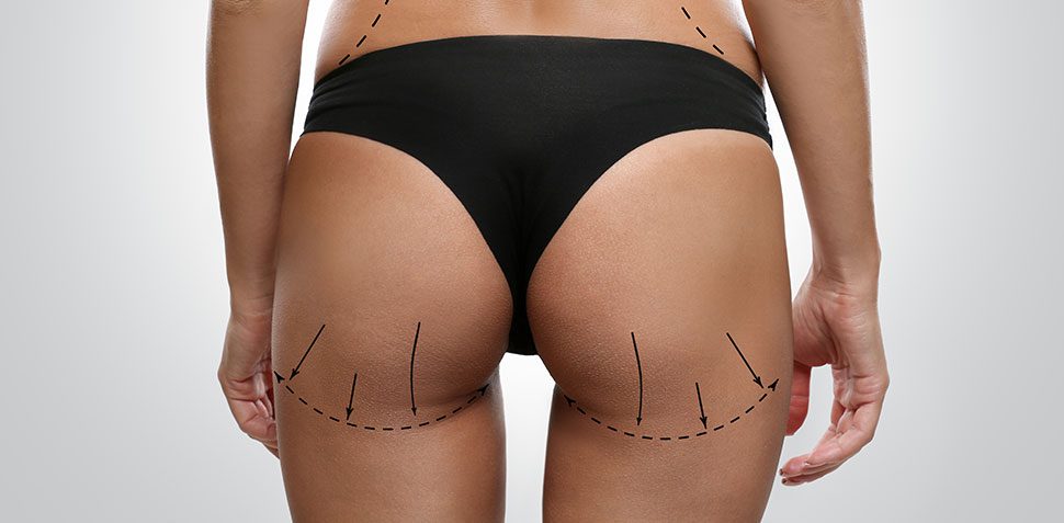 Brazilian Butt Lift Back Support Cushion Dr. Approved Foam Back Support for BBL  Pillow Post Surgery Recovery Comfortable and Firm After Surgery - BBL  Recovery Post-Op Sitting